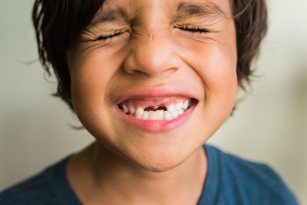 Grinning Child With Gap For Missing Front Teeth